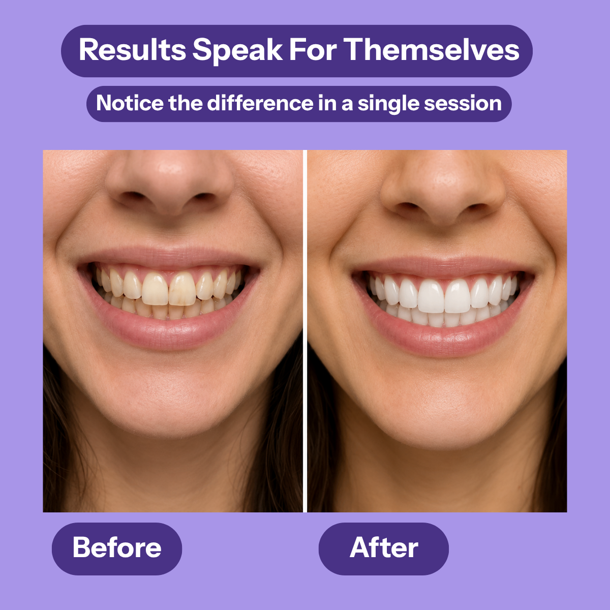 SmileArc™ Teeth Whitening Strips